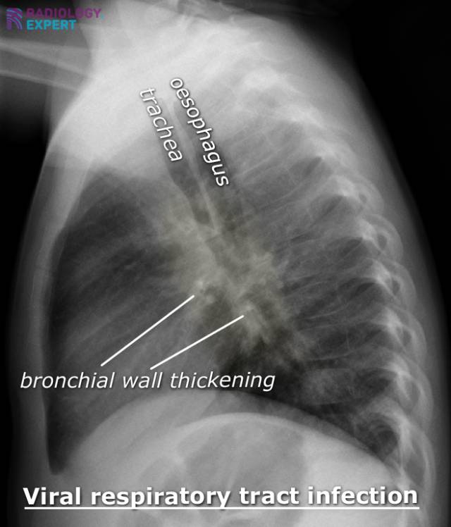 Chest Xray child